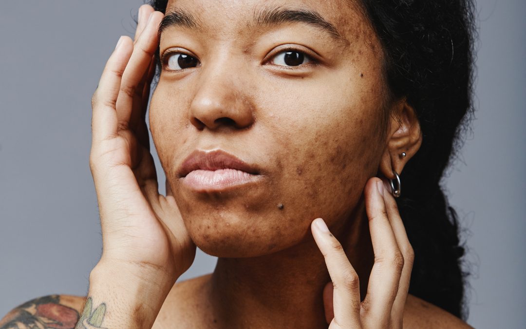 Transformative Solutions for Hyperpigmentation with Chemical Peels in HEALTH AND SKINCARE / SOMATOLOGY